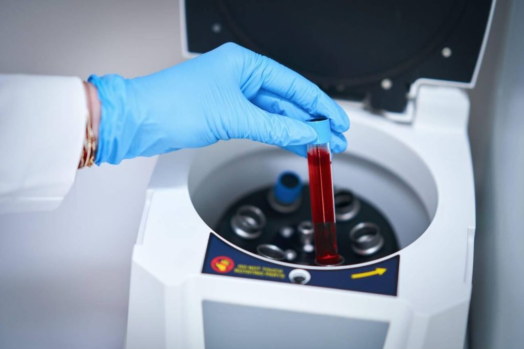 Liquid Biopsy Screening Trials Report Early Findings A blood sample in a laboratory